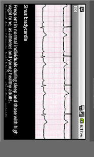 Electrocardiogram ECG Types(圖3)-速報App