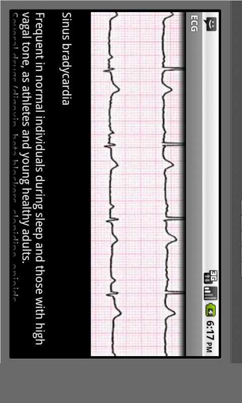 Electrocardiogram ECG Types Screen 3