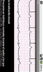 Electrocardiograma ECG Tipos(圖6)-速報App