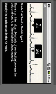 Electrocardiogram ECG Types(圖5)-速報App