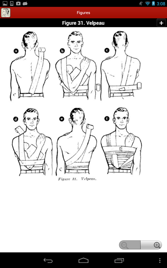 Splinting Techniques Chart